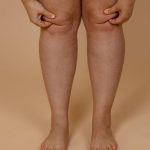 cropped-photo-woman-bare-naked-legs-pinching-fat-knees-clipping-fat-folds-body-care-fat-pumping-varicose-skin.jpg